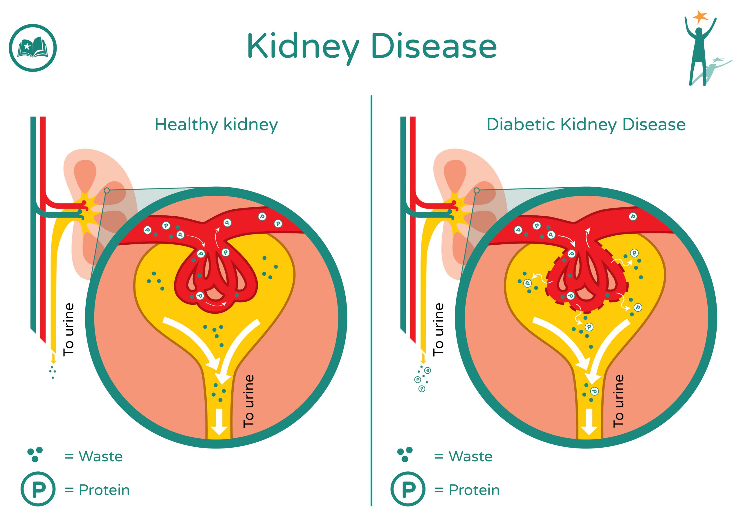 diabetes-and-kidneys-preventing-diabetes-elearning