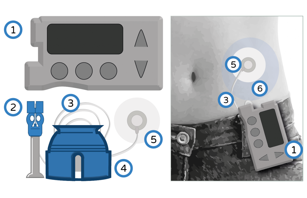 Diagram showing the different parts of a pump and where it attaches on to your body