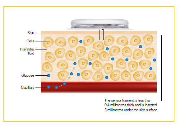 Diagram showing the sensor sitting on top of the skin; layer underneath comprising of interstitial fluid and cells with glucose molecules entering from the capillary. The sensor filament is less than 0.4 mm thick and is inserted 5 mm under the skin surface