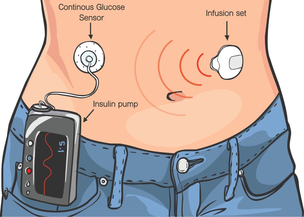 Illustration showing an abdomen with an insulin pump, infusion set and continuous glucose monitor attached